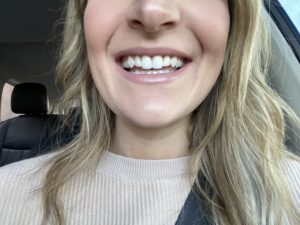 My Invisalign Experience | Audrey Madison Stowe a fashion and lifestyle blogger