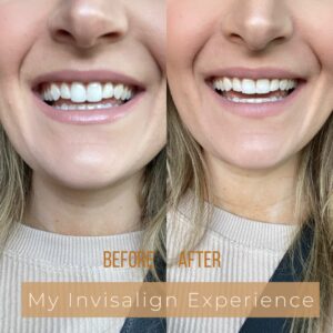 My Invisalign Experience | Audrey Madison Stowe a fashion and lifestyle blogger