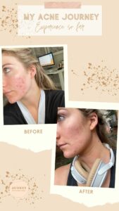 My Battle with Adult Acne | Fashion blogger skin journey with adult acne