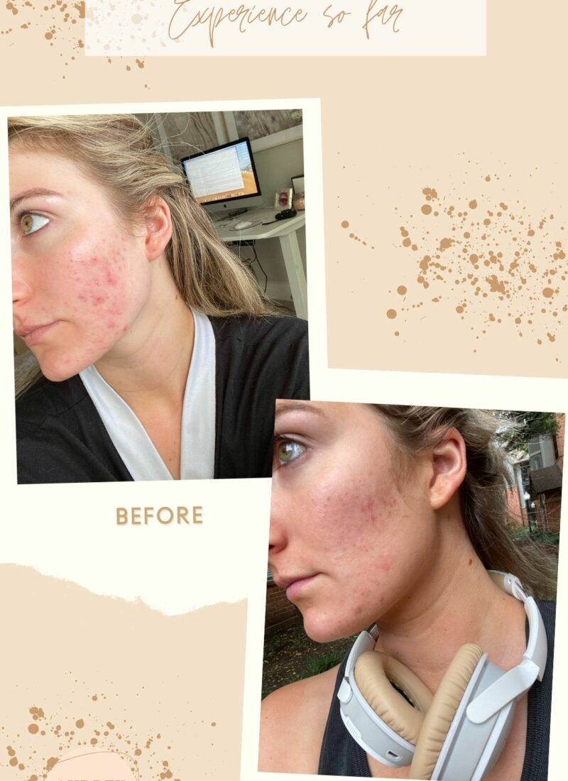My Battle with Adult Acne | Fashion blogger skin journey with adult acne
