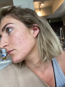 My Skin Journey with Adult Acne | Acne breakouts