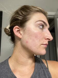 clearing up my skin + my battle with acne