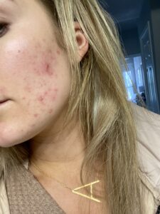 My Skin Journey with Adult Acne