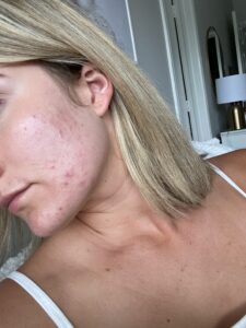 My Skin Journey with Adult Acne